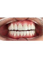 Dental Crowns - Fuzir 1 - Camtu Dental Clinic