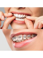 Orthodontic Retainer - Camtu Dental Clinic