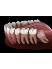 Wisdom Tooth Extraction - Camtu Dental Clinic