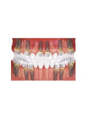 All-on-8 Implant Package (Straumann) - Camtu Dental Clinic