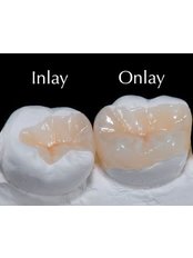 Composite Resin Inlay or Onlay - Camtu Dental Clinic