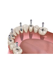 All-on-6 Implant Package (USA) - Camtu Dental Clinic
