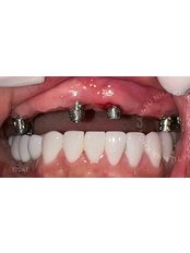 All-on-4 Implant Package (Straumann) - Camtu Dental Clinic