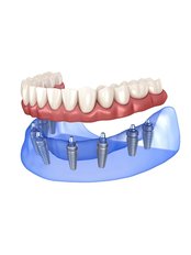 All-on-8 Implant Package (USA) - Camtu Dental Clinic