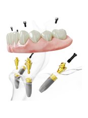 All-on-4 Implant Package (Nobel) - Camtu Dental Clinic