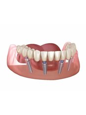 All-on-4 Implant Package (USA) - Camtu Dental Clinic
