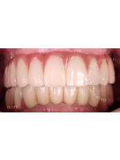 All-on-6 Implant Package (Nobel) - Camtu Dental Clinic