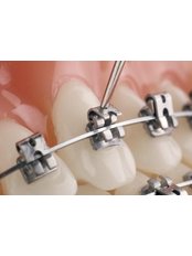 Metal Self-Ligating Braces - Camtu Dental Clinic