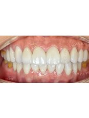 Dental Crowns - Bio DT 1 - Camtu Dental Clinic