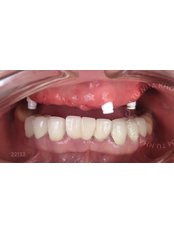 All-on-4 Implant Package (Korea) - Camtu Dental Clinic