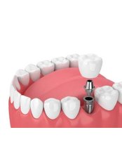Single Implant (Straumann) - Camtu Dental Clinic