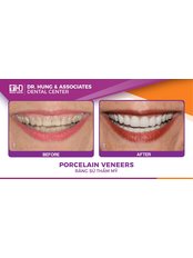 Veneers - Worldwide Dental & Cosmetic Surgery Hospital (fka Dr. Hung & Associates Dental Center)