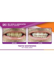 Teeth Whitening - Worldwide Dental & Cosmetic Surgery Hospital (fka Dr. Hung & Associates Dental Center)