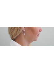 Non-Surgical Facelift - Esthe Laser Clinic