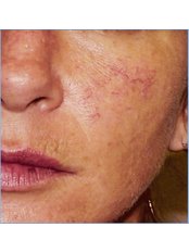 Facial Thread Veins Treatment - Esthe Laser Clinic