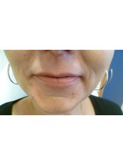 Lip Augmentation - Esthe Laser Clinic