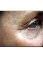 Facial Rejuvenation - Esthe Laser Clinic