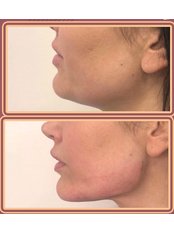 Jaw Filler - Texas Technique for Sculpting the Chin area - Dr. Emad Farag