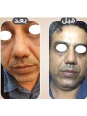 Hyaluronic Injections - Treatment of Dark Circles - Dr. Emad Farag