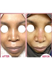 Facial Rejuvenation - Plasmage - Dr. Emad Farag