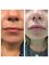 Shrey Hospital - Lip Fillers - Before & After 