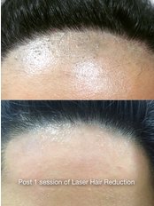 Laser Hair Removal - Zolie Skin Clinic - Delhi