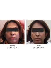 Facelift - Skin Allure Aesthetic Clinic
