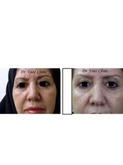 Treatment for Wrinkles with Fractional laser or Fractional RF (INFINI) - Dr Vaez Shooshtari clinic