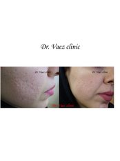 Acne Scars Treatment - Dr Vaez Shooshtari clinic