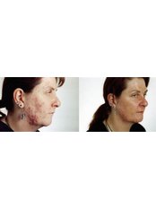 Acne Treatment - The Skin Specialist