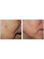Laser Wrinkle Reduction - Estee Asia Clinic