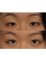 Alka Cosmetic Dermatology - Blepharoplasty / Asian eye lid surgery 
