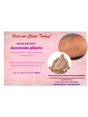 Keratosis Pilaris Treatment - The Garden Skin Clinic