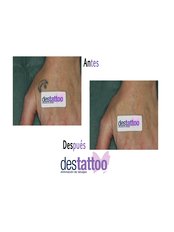 Dermatologist Consultation - DESTATTOO