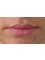 Dermist Cosmetic Dermatology and Laser Clinic - lips before 