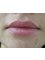 Dermist Cosmetic Dermatology and Laser Clinic - lips after 