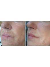Profhilo® - Southface Skin Clinic