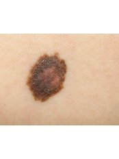 Skin Cancer Removal and Testing x 1 - Abbey Field Medical Practice