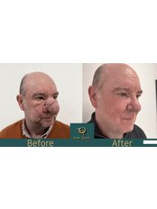 Rhinophyma - CO2 and Erbium Laser - Ever Clinic