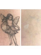 Tattoo Removal - Appear Natural Aesthetics