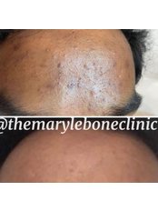 Acne Scars Treatment - The Marylebone Clinic - Harley Street