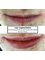 Derm Design by Dr Natalie Miller - Lip Augmentation 