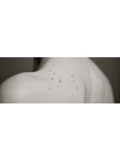 Skin Cancer Screening / Full Body Mole Check - Diamond Skin Care
