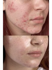 Acne Cure Consultation (treatment) - Diamond Skin Care