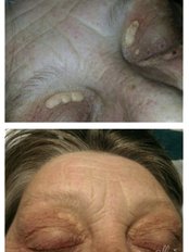Advanced Cosmetic Removal by Sterex - Park Grange Advanced Skin Clinic
