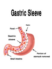 Gastric Sleeve - Valli Hospital