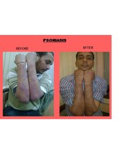 Psoriasis Treatment - Aura Homeopathy Clinic & Research Centre India