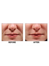 Non-Surgical Facelift - Specialist Cosmetic Clinic