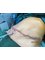 DR. SARANG' liposuction&  weight loss clinic - tummy_tuck_post_surgery_photo_pt_of_de_sarang_degloorkar 