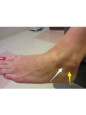 Ankle Injury Treatment - Happi Rehab Center